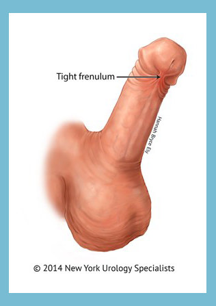 Frénulectomie pénienne ottawa gatineau