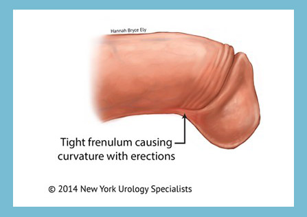 Penile frenulectomy Ottawa